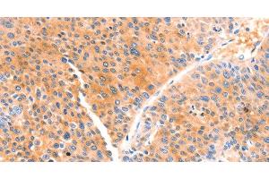 Immunohistochemistry of paraffin-embedded Human liver cancer using PRDX2 Polyclonal Antibody at dilution of 1:80 (Peroxiredoxin 2 antibody)