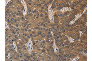 The image on the left is immunohistochemistry of paraffin-embedded Human liver cancer tissue using ABIN7129190(DEGS1 Antibody) at dilution 1/40, on the right is treated with fusion protein. (DEGS1 antibody)