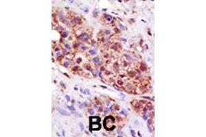 Formalin-fixed and paraffin-embedded human cancer tissue reacted with the primary antibody, which was peroxidase-conjugated to the secondary antibody, followed by DAB staining. (UBE2B antibody  (C-Term))