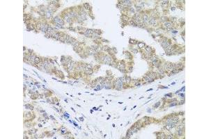 Immunohistochemistry of paraffin-embedded Human liver cancer using TIMM10B Polyclonal Antibody at dilution of 1:100 (40x lens).