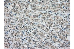 Immunohistochemical staining of paraffin-embedded Carcinoma of kidney tissue using anti-BUB1Bmouse monoclonal antibody. (BUB1B antibody)