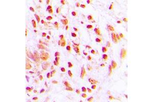 Immunohistochemical analysis of Histone H4 (AcK16) staining in human lung cancer formalin fixed paraffin embedded tissue section.