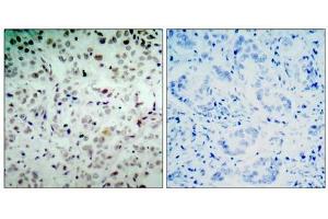 Immunohistochemical analysis of paraffin- embedded human breast carcinoma tissue, using Rb (phospho-Ser780) antibody (E011132) . (Retinoblastoma 1 antibody  (pSer780))