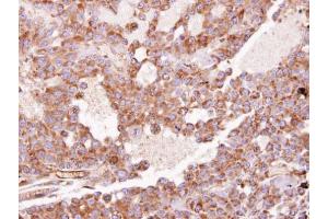 IHC-P Image Immunohistochemical analysis of paraffin-embedded HUH7 xenograft, using RhoGDI, antibody at 1:100 dilution. (ARHGDIA antibody)