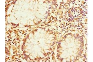 Immunohistochemistry of paraffin-embedded human colon cancer using ABIN7167162 at dilution of 1:100