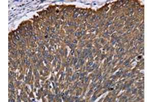 The image on the left is immunohistochemistry of paraffin-embedded Human lung cancer tissue using ABIN7130044(KRT31 Antibody) at dilution 1/30, on the right is treated with fusion protein.