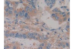 Detection of Hpt in Human Breast cancer Tissue using Polyclonal Antibody to Haptoglobin (Hpt) (Haptoglobin antibody  (AA 44-157))