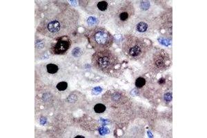 Immunohistochemical analysis of PRMT2 staining in human liver cancer formalin fixed paraffin embedded tissue section. (PRMT2 antibody)
