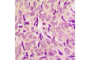 Immunohistochemical analysis of RPS6 (pS240) staining in human breast cancer formalin fixed paraffin embedded tissue section. (RPS6 antibody  (C-Term, pSer240))
