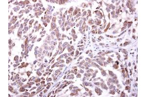 IHC-P Image NKG2D antibody [N3C2], Internal detects NKG2D protein at cytosol on human lung carcinoma by immunohistochemical analysis. (KLRK1 antibody  (Internal Region))