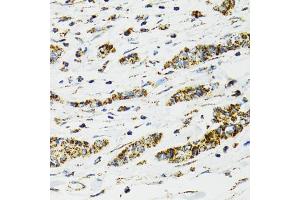 Immunohistochemistry of paraffin-embedded human breast cancer using HSPA9 antibody (ABIN5970207) at dilution of 1/100 (40x lens). (HSPA9 antibody)