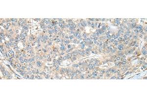 Immunohistochemistry of paraffin-embedded Human liver cancer tissue using CASR Polyclonal Antibody at dilution of 1:60(x200) (CASR antibody)