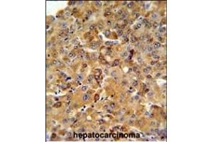 SFT2D3 Antibody (N-term) (ABIN651461 and ABIN2840253) IHC analysis in formalin fixed and paraffin embedded human hepatocarcinoma followed by peroxidase conjugation of the secondary antibody and DAB staining.
