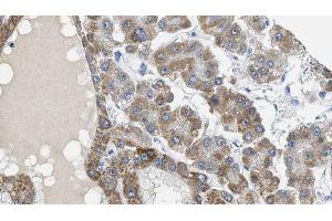 ABIN6269057 at 1/100 staining Human liver cancer tissue by IHC-P. (MAP3K7 antibody  (Internal Region))