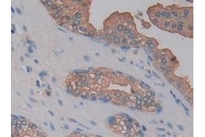 Detection of KLK10 in Human Prostate Tissue using Polyclonal Antibody to Kallikrein 10 (KLK10) (Kallikrein 10 antibody  (AA 35-276))