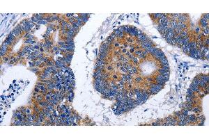 Immunohistochemistry of paraffin-embedded Human colon cancer using EEF1 gamma Polyclonal Antibody at dilution of 1:50 (EEF1G antibody)