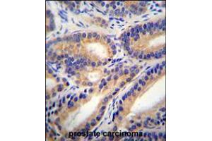 HSD11B1L Antibody immunohistochemistry analysis in formalin fixed and paraffin embedded human prostate carcinoma followed by peroxidase conjugation of the secondary antibody and DAB staining. (HSD11B1L antibody  (C-Term))