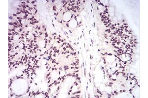 Immunohistochemical analysis of paraffin-embedded colon cancer tissues using DNMT1 mouse mAb with DAB staining. (DNMT1 antibody  (AA 1317-1616))