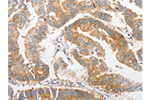 The image on the left is immunohistochemistry of paraffin-embedded Human colon cancer tissue using ABIN7128369(ALPI Antibody) at dilution 1/25, on the right is treated with fusion protein. (Intestinal Alkaline Phosphatase antibody)