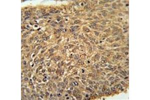 ATG13 antibody immunohistochemistry analysis in formalin fixed and paraffin embedded human lung carcinoma. (ATG13 antibody  (AA 1-30))
