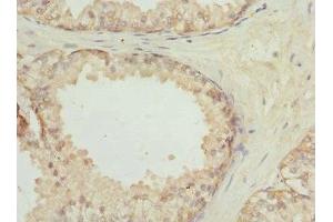 Immunohistochemistry of paraffin-embedded human prostate cancer using ABIN7153465 at dilution of 1:100 (LGALS8 antibody  (AA 20-317))