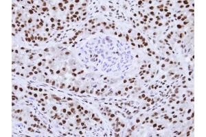 Immunohistochemical staining of paraffin-embedded A549 Xenograft using hnRNP F antibody at a dilution of 1:100 (HNRNPF antibody)