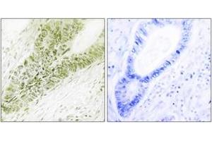 Immunohistochemistry analysis of paraffin-embedded human colon carcinoma tissue, using Ubinuclein Antibody. (Ubinuclein 1 antibody  (AA 161-210))