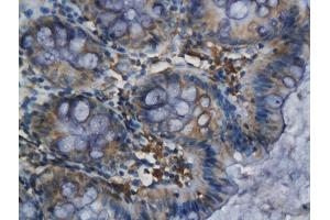 Formalin-fixed and paraffin embedded human colorectal cancer labeled with Anti-ELAVL1/HUR Polyclonal Antibody, Unconjugated (ABIN748583) followed by conjugation to the secondary antibody and DAB staining (ELAVL1 antibody)