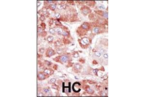 Formalin-fixed and paraffin-embedded human cancer tissue reacted with the primary antibody, which was peroxidase-conjugated to the secondary antibody, followed by AEC staining. (GRK7 antibody  (C-Term))