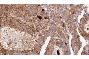 ABIN6276856 at 1/100 staining Human liver cancer tissue by IHC-P. (Fc epsilon RI/FCER1A antibody  (C-Term))