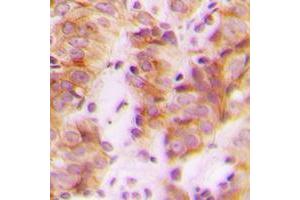 Immunohistochemical analysis of RPL30 staining in human breast cancer formalin fixed paraffin embedded tissue section. (RPL30 antibody  (C-Term))