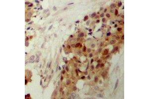 Immunohistochemical analysis of p38 (pY182) staining in human breast cancer formalin fixed paraffin embedded tissue section. (MAPK14 antibody  (pTyr182))