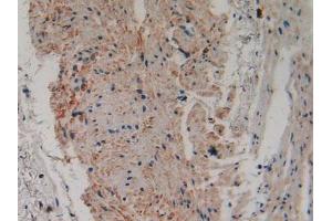 IHC-P analysis of Human Stomach Cancer Tissue, with DAB staining. (PLA2G4A antibody  (AA 563-749))