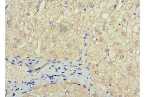 Immunohistochemistry of paraffin-embedded human liver cancer using ABIN7172606 at dilution of 1:100 (SOX14 antibody  (AA 1-137))