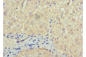 Immunohistochemistry of paraffin-embedded human liver cancer using ABIN7172606 at dilution of 1:100