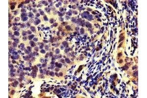 IHC image of ABIN7142292 diluted at 1:200 and staining in paraffin-embedded human pancreatic cancer performed on a Leica BondTM system. (HMGCR antibody  (AA 588-887))