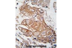 Formalin-fixed and paraffin-embedded human lung carcinoma tissue reacted with Phospho-RGS19-p. (RGS19 antibody  (AA 131-156))