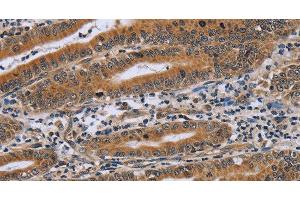 Immunohistochemistry of paraffin-embedded Human gastric cancer using NDUFAF4 Polyclonal Antibody at dilution of 1:45 (NDUFAF4 antibody)