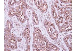 IHC-P Image Immunohistochemical analysis of paraffin-embedded human breast cancer, using NDUFS5, antibody at 1:250 dilution. (NDUFS5 antibody  (Center))