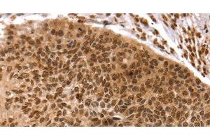 Immunohistochemistry of paraffin-embedded Human esophagus cancer using TAF10 Polyclonal Antibody at dilution of 1:35 (TAF10 antibody)