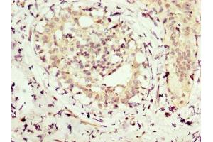 IHC image of ABIN7154254 diluted at 1:300 and staining in paraffin-embedded human breast cancer performed on a Leica BondTM system. (NMT1 antibody  (AA 1-158))