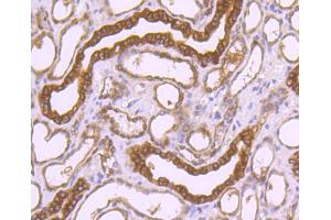 Paraformaldehyde-fixed, paraffin embedded human liver carcinoma, Antigen retrieval by boiling in sodium citrate buffer (pH6) for 15min, Block endogenous peroxidase by 3% hydrogen peroxide for 30 minutes, Blocking buffer (normal serum) at 37°C for 20min, Antibody incubation with Peroxiredoxin 1 (7A1) Monoclonal Antibody  at 1:50 overnight at 4°C, followed by a conjugated secondary and DAB staining. (Peroxiredoxin 1 antibody)