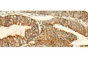 Immunohistochemistry of paraffin-embedded Human colorectal cancer tissue using IFT27 Polyclonal Antibody at dilution of 1:50(x200) (RABL4 antibody)