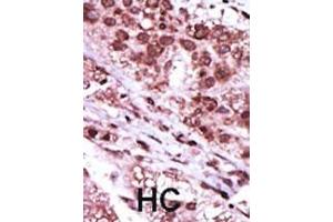 Formalin-fixed and paraffin-embedded human cancer tissue reacted with the primary antibody, which was peroxidase-conjugated to the secondary antibody, followed by DAB staining. (GSK3 beta antibody  (N-Term))