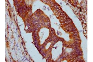IHC image of ABIN7154052 diluted at 1:500 and staining in paraffin-embedded human colon cancer performed on a Leica BondTM system. (GLRX5 antibody  (AA 32-157))