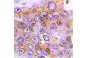 Immunohistochemical analysis of Arylsulfatase D staining in human lung cancer formalin fixed paraffin embedded tissue section. (Arylsulfatase D antibody  (Center))