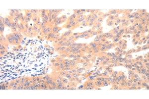 Immunohistochemistry of paraffin-embedded Human ovarian cancer using BGLAP Polyclonal Antibody at dilution of 1:40 (Osteocalcin antibody)
