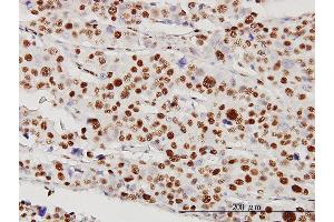 Immunoperoxidase of monoclonal antibody to STK38 on formalin-fixed paraffin-embedded human malignant lymphoma, diffuse large B tissue [antibody concentration 5 ug/ml] (STK38 antibody  (AA 1-465))