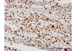 Immunoperoxidase of monoclonal antibody to STK38 on formalin-fixed paraffin-embedded human malignant lymphoma, diffuse large B tissue [antibody concentration 5 ug/ml]