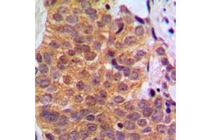 Immunohistochemical analysis of RAR beta staining in human breast cancer formalin fixed paraffin embedded tissue section. (Retinoic Acid Receptor beta antibody  (C-Term))